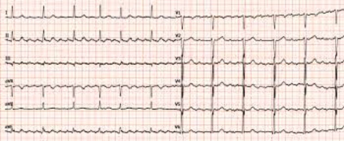  Atrial Flutter