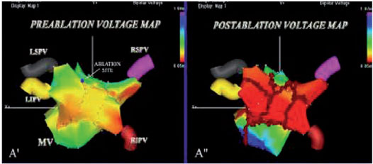 Atrial Fibrillation (AF) Ablation