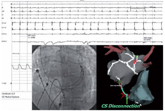 Atrial Fibrillation (AF) Ablation