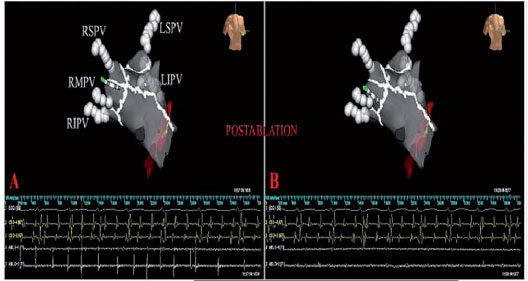 Atrial Fibrillation (AF) Ablation