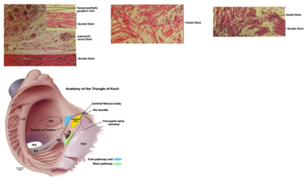 Ablazione Transcatetere della Tachicardia da Rientro Nodale 