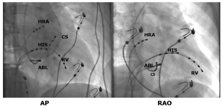 Ablazione Transcatetere della Tachicardia da Rientro Nodale 