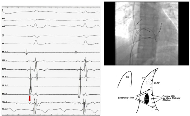 ablazione-rientro-nodale