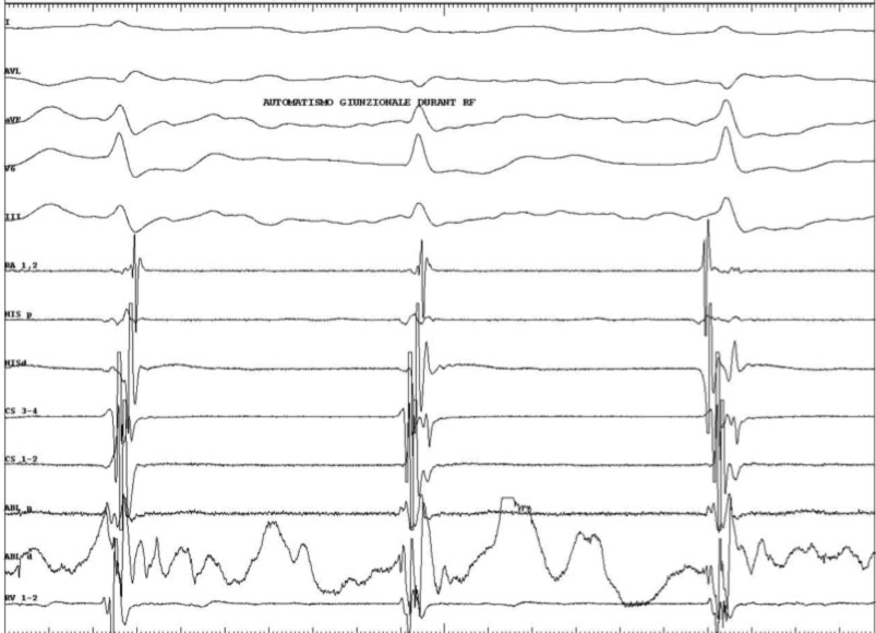 ablazione-rientro-nodale