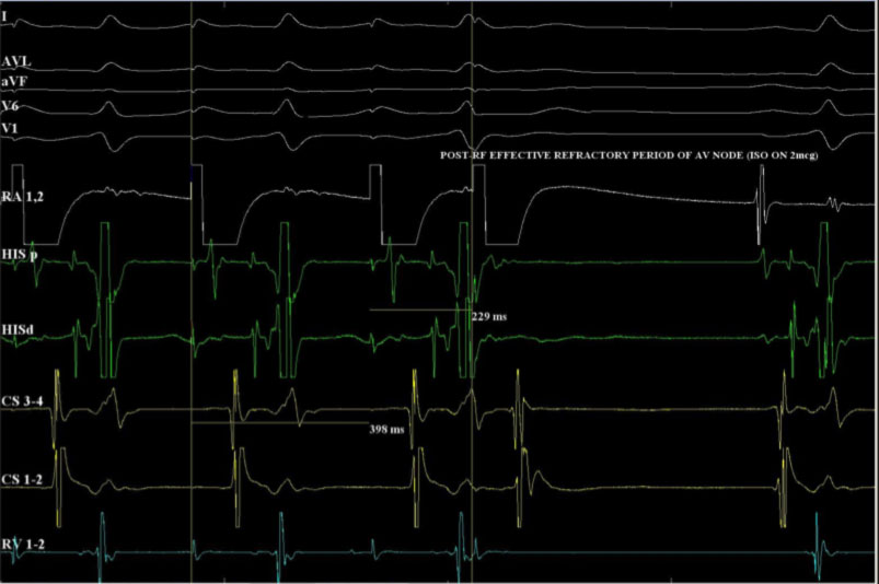 ablazione-rientro-nodale