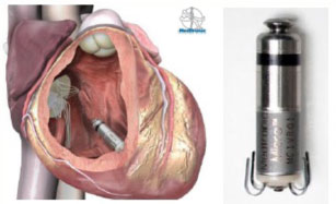 MICRA device implanted in the wall of the right ventricle