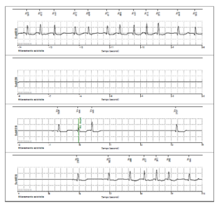 tracciato ECG bradiaritmie