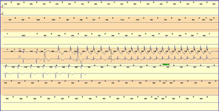 Tachicardia ventricolare monomorfa (13 sec) in paziente con DCM (FEVS 25%)
