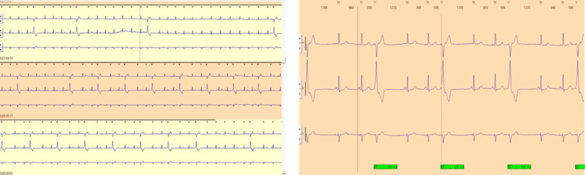 ECG standard - ECG dinamico