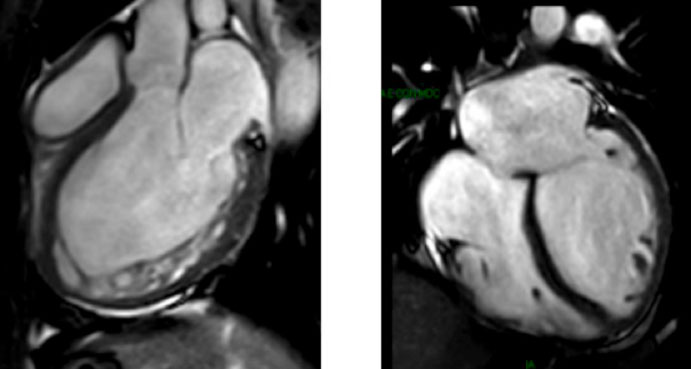 risonanza magnetica cardiaca